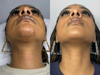 Layali Follicle Calm Oil (Buy 1 Get 1 Free)
